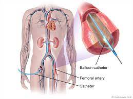 Peripheral Angiography