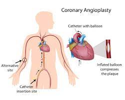 coronary Angiplast